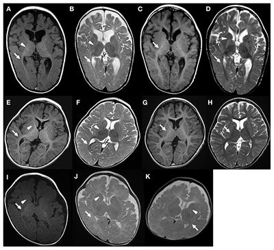Regional Difference in Myelination in Monocarboxylate Transporter 8 Deficiency: Case Reports and Literature Review of Cases in Japan